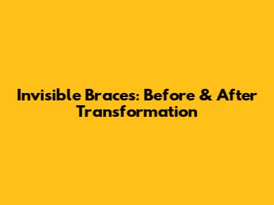Invisible Braces: Before & After Transformation